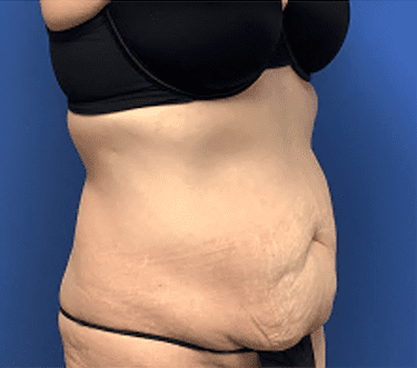 Tummy Tuck Before & After Patient #2814