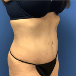 Tummy Tuck Before & After Patient #2814