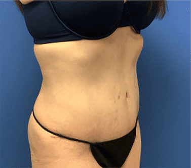 Tummy Tuck Before & After Patient #2814