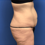 Tummy Tuck Before & After Patient #2814