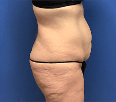 Tummy Tuck Before & After Patient #2814