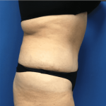 Tummy Tuck Before & After Patient #2819