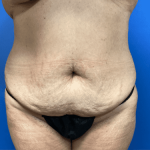 Tummy Tuck Before & After Patient #2819