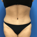 Tummy Tuck Before & After Patient #2819