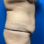 Tummy Tuck Before & After Patient #2819