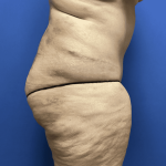 Tummy Tuck Before & After Patient #2824
