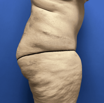 Tummy Tuck Before & After Patient #2824