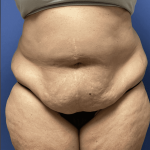 Tummy Tuck Before & After Patient #2824