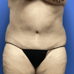 Tummy Tuck Before & After Patient #2824