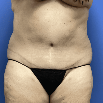 Tummy Tuck Before & After Patient #2824
