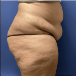 Tummy Tuck Before & After Patient #2824
