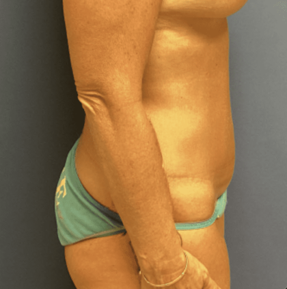 Tummy Tuck Before & After Patient #2829