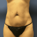 Tummy Tuck Before & After Patient #2829