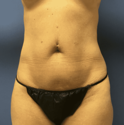 Tummy Tuck Before & After Patient #2829