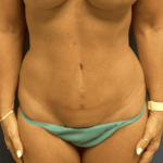 Tummy Tuck Before & After Patient #2829