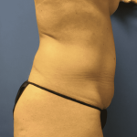 Tummy Tuck Before & After Patient #2829