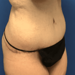 Tummy Tuck Before & After Patient #2834