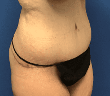 Tummy Tuck Before & After Patient #2834