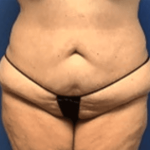 Tummy Tuck Before & After Patient #2834