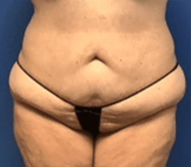 Tummy Tuck Before & After Patient #2834