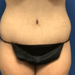 Tummy Tuck Before & After Patient #2834