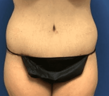 Tummy Tuck Before & After Patient #2834