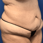 Tummy Tuck Before & After Patient #2834