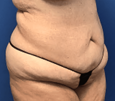 Tummy Tuck Before & After Patient #2834