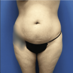 Tummy Tuck Before & After Patient #2839