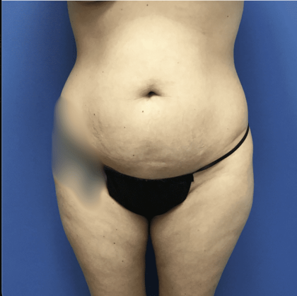 Tummy Tuck Before & After Patient #2839