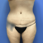 Tummy Tuck Before & After Patient #2839