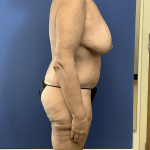 Tummy Tuck Before & After Patient #2842