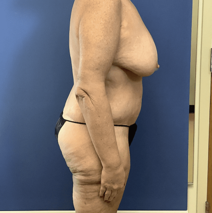 Tummy Tuck Before & After Patient #2842