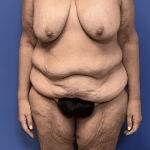 Tummy Tuck Before & After Patient #2842