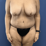 Tummy Tuck Before & After Patient #2842