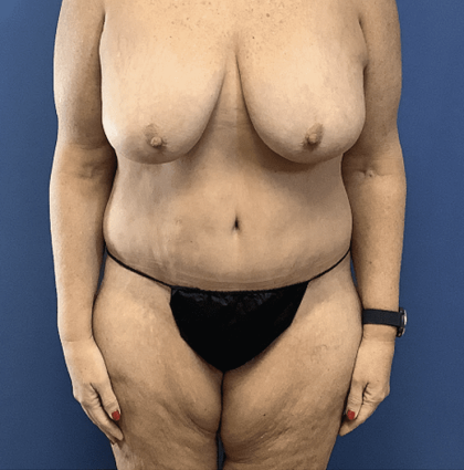 Tummy Tuck Before & After Patient #2842