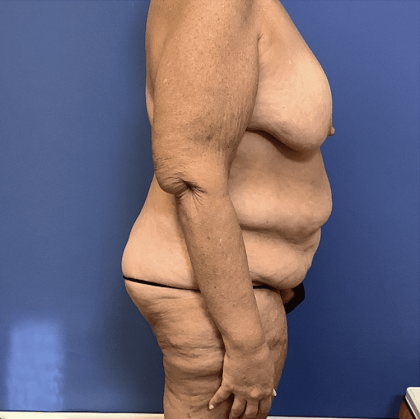 Tummy Tuck Before & After Patient #2842