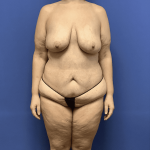 Tummy Tuck Before & After Patient #2847