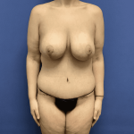 Tummy Tuck Before & After Patient #2847
