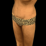 Tummy Tuck Before & After Patient #2850