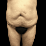 Tummy Tuck Before & After Patient #2850