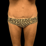 Tummy Tuck Before & After Patient #2850