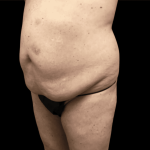 Tummy Tuck Before & After Patient #2850