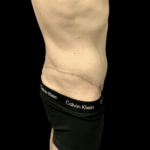 Tummy Tuck Before & After Patient #2855