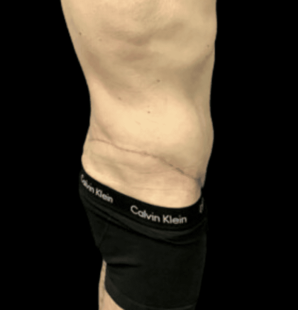 Tummy Tuck Before & After Patient #2855