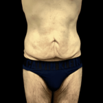 Tummy Tuck Before & After Patient #2855