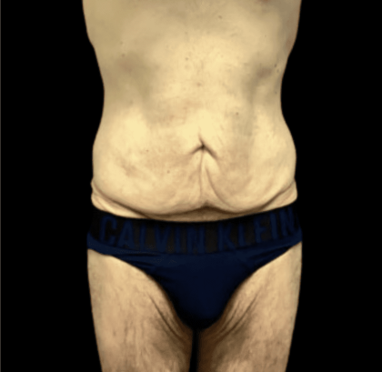 Tummy Tuck Before & After Patient #2855