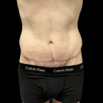 Tummy Tuck Before & After Patient #2855