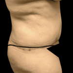 Tummy Tuck Before & After Patient #2870
