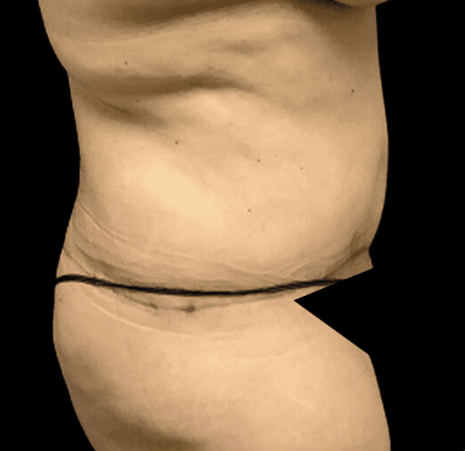 Tummy Tuck Before & After Patient #2870